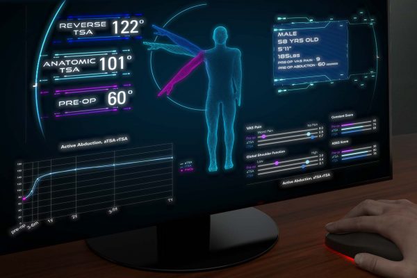 Decision Making in Shoulder Arthroplasty using Exactech Active Intelligence AI Technology Predict+