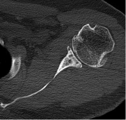 Shoulder Preoperative planning Xray