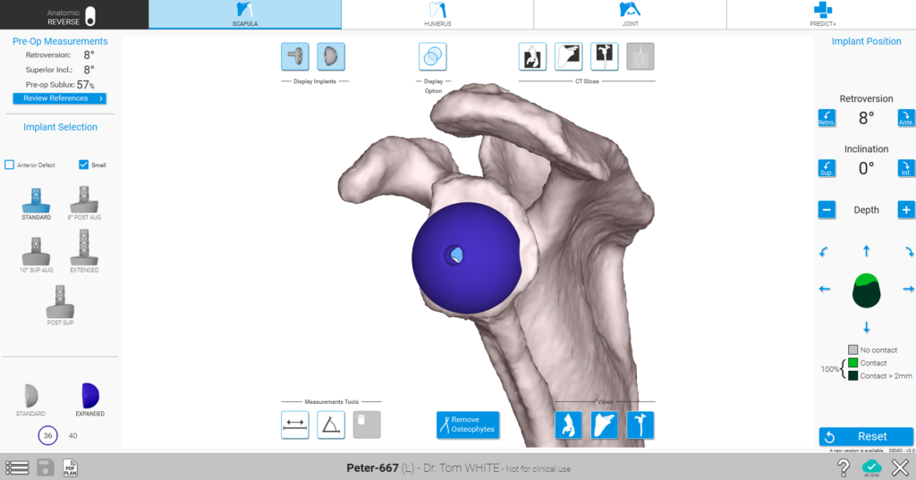 Shoulder Planning App for Scapula Planning Screen