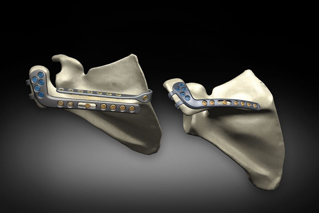 FDA Clearance of First-to-Market Scapula Reconstruction System for Acromial Stress Fractures Equinoxe
