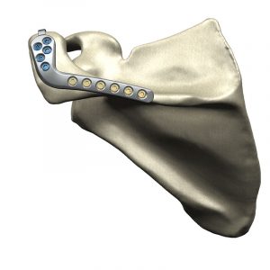 Equinoxe Scapula Reconstruction System for Acromial Stress Fractures Anterior Hook Plate