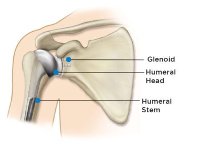 Equinoxe Anatomic Shoulder Replacement Illustration