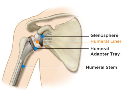 Equinoxe Reverse Shoulder Replacement Illustration