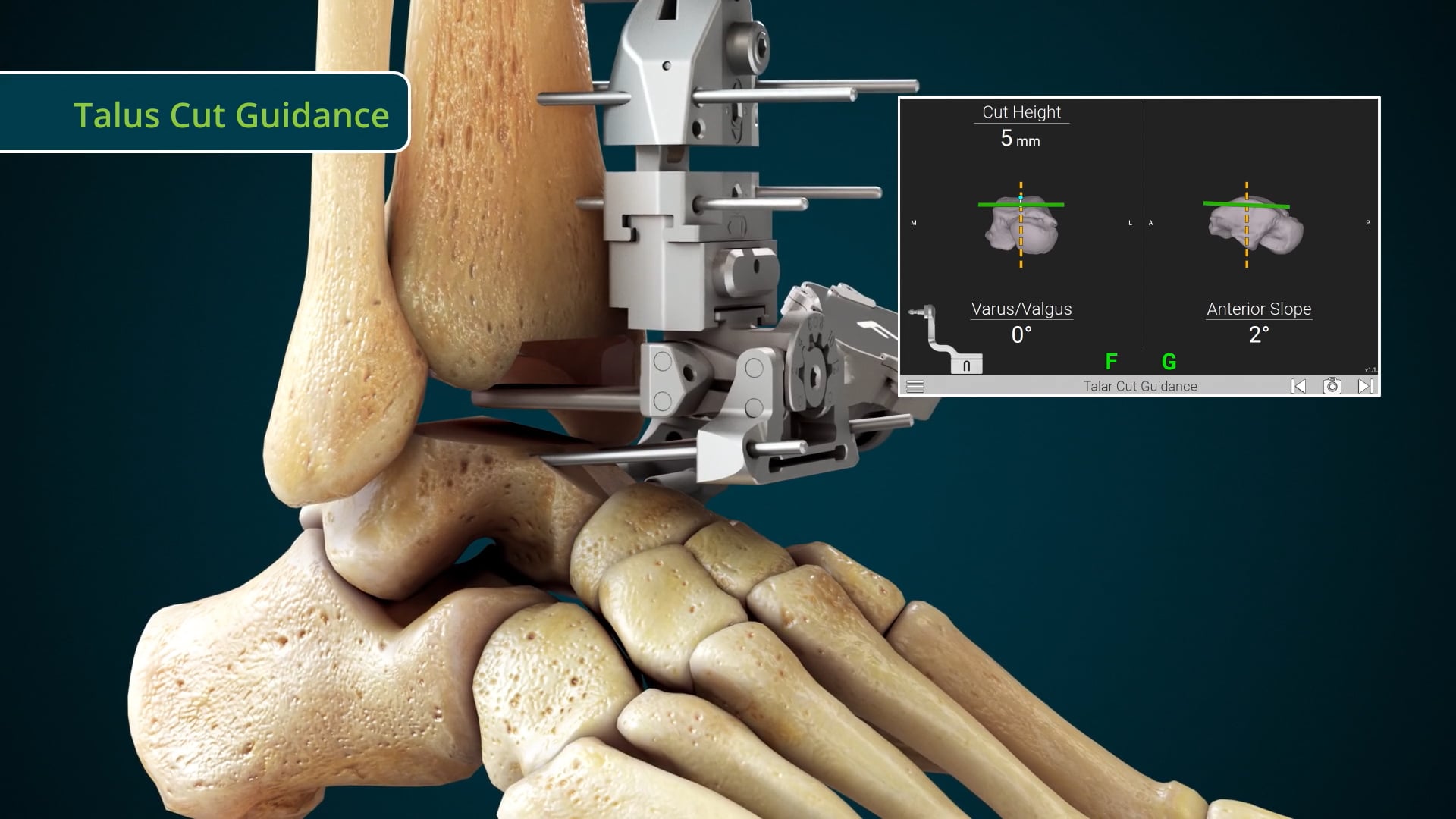 Advita GPS Ankle TAA Surgical Animation